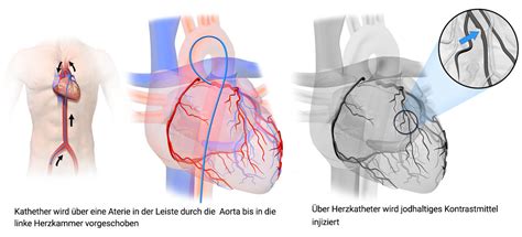 koronarangiographie durchführung